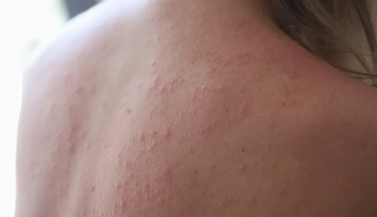 Roter Ausschlag und kleine Pickelchen auf der Haut, die auf Stress pusteln hindeuten.