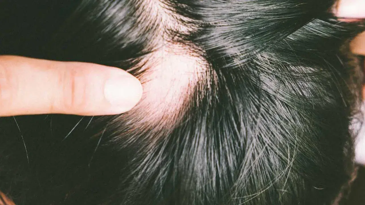 Ein Finger hebt eine Stelle mit sichtbarem Haarausfall beim Haare waschen hervor. Die Kopfhaut ist gerötet.