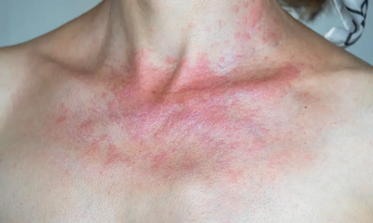 Rotes Dekolleté wie Sonnenbrand, mit roten Flecken und Schuppen.