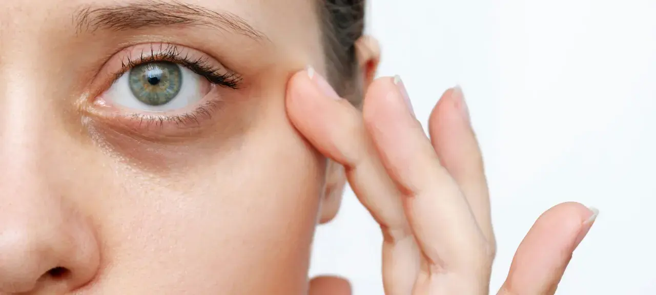 Nahaufnahme eines Auges mit sichtbaren Augenringen. Ein Finger berührt sanft die Haut unter dem Auge, als würde man zeigen, wie schminke ich augenringe weg.