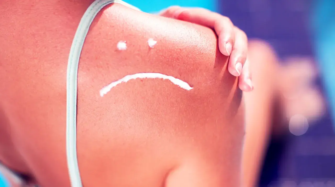 Sonnenbrand auf der Schulter mit traurigem Gesicht aus Creme. Hilfreiche hausmittel bei sonnenbrand lindern die Beschwerden.