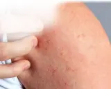Rote, gereizte Haut mit kleinen Pickelchen, die auf Stress Juckreiz hindeuten. Ein Finger kratzt an der betroffenen Stelle.