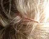 Nahaufnahme einer Kopfhaut mit feinen Haaren. Ein dünner, kupferfarbener Gegenstand liegt auf der Haut. Was tun bei juckender Kopfhaut?