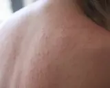 Roter Ausschlag und kleine Pickelchen auf der Haut, die auf Stress pusteln hindeuten.