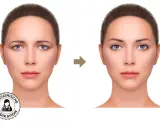 Vorher-Nachher-Vergleich: Was ist Brow Lifting? Die Augenbrauen sind angehoben, das Gesicht wirkt jugendlicher und offener.