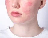 Rötungen im Gesicht, ein mögliches Zeichen für Stress symptome haut. Die Haut ist gerötet, besonders auf den Wangen.