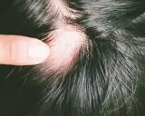 Ein Finger hebt eine Stelle mit sichtbarem Haarausfall beim Haare waschen hervor. Die Kopfhaut ist gerötet.