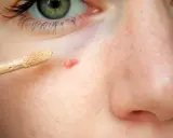 Ein Concealer-Applikator nähert sich einem roten Pickel mit Kruste, um ihn abzudecken.