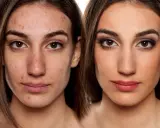 Vorher-Nachher-Vergleich: Haut mit Akne und perfekt geschminktes Gesicht. Hausmittel zum Make-up fixieren können helfen.