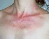 Rotes Dekolleté wie Sonnenbrand, mit roten Flecken und Schuppen.