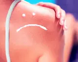 Sonnenbrand auf der Schulter mit traurigem Gesicht aus Creme. Hilfreiche hausmittel bei sonnenbrand lindern die Beschwerden.