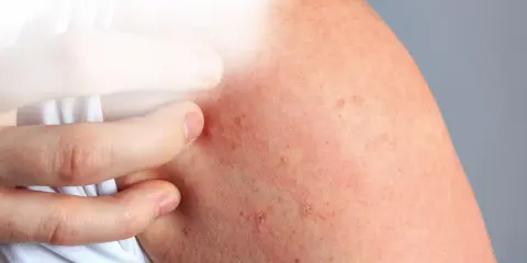 Rote, gereizte Haut mit kleinen Pickelchen, die auf Stress Juckreiz hindeuten. Ein Finger kratzt an der betroffenen Stelle.