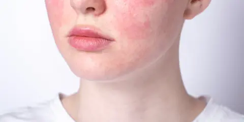 Rötungen im Gesicht, ein mögliches Zeichen für Stress symptome haut. Die Haut ist gerötet, besonders auf den Wangen.