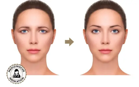 Vorher-Nachher-Vergleich: Was ist Brow Lifting? Die Augenbrauen sind angehoben, das Gesicht wirkt jugendlicher und offener.
