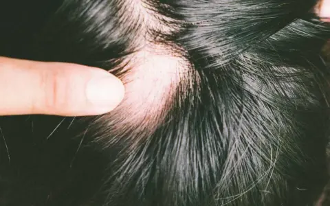 Ein Finger hebt eine Stelle mit sichtbarem Haarausfall beim Haare waschen hervor. Die Kopfhaut ist gerötet.