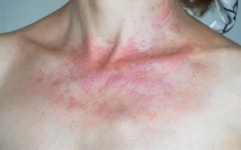 Rotes Dekolleté wie Sonnenbrand, mit roten Flecken und Schuppen.