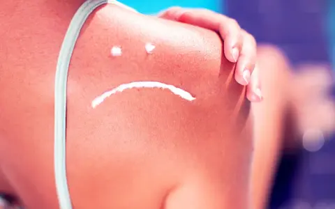 Sonnenbrand auf der Schulter mit traurigem Gesicht aus Creme. Hilfreiche hausmittel bei sonnenbrand lindern die Beschwerden.