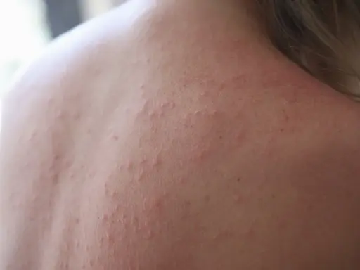 Roter Ausschlag und kleine Pickelchen auf der Haut, die auf Stress pusteln hindeuten.