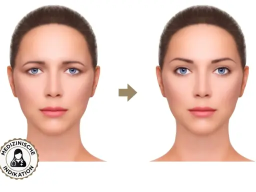 Vorher-Nachher-Vergleich: Was ist Brow Lifting? Die Augenbrauen sind angehoben, das Gesicht wirkt jugendlicher und offener.