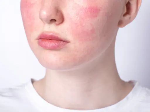 Rötungen im Gesicht, ein mögliches Zeichen für Stress symptome haut. Die Haut ist gerötet, besonders auf den Wangen.