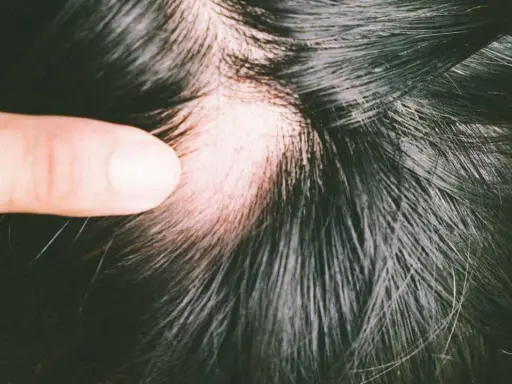 Ein Finger hebt eine Stelle mit sichtbarem Haarausfall beim Haare waschen hervor. Die Kopfhaut ist gerötet.