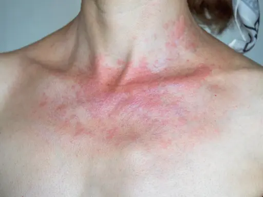 Rotes Dekolleté wie Sonnenbrand, mit roten Flecken und Schuppen.