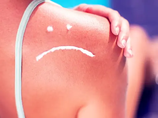 Sonnenbrand auf der Schulter mit traurigem Gesicht aus Creme. Hilfreiche hausmittel bei sonnenbrand lindern die Beschwerden.