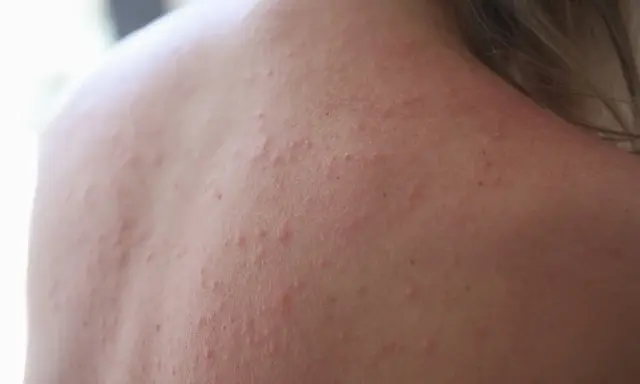 Roter Ausschlag und kleine Pickelchen auf der Haut, die auf Stress pusteln hindeuten.