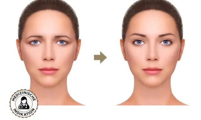 Vorher-Nachher-Vergleich: Was ist Brow Lifting? Die Augenbrauen sind angehoben, das Gesicht wirkt jugendlicher und offener.