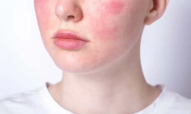 Rötungen im Gesicht, ein mögliches Zeichen für Stress symptome haut. Die Haut ist gerötet, besonders auf den Wangen.