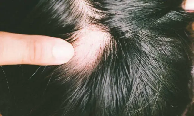 Ein Finger hebt eine Stelle mit sichtbarem Haarausfall beim Haare waschen hervor. Die Kopfhaut ist gerötet.