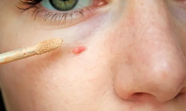 Ein Concealer-Applikator nähert sich einem roten Pickel mit Kruste, um ihn abzudecken.