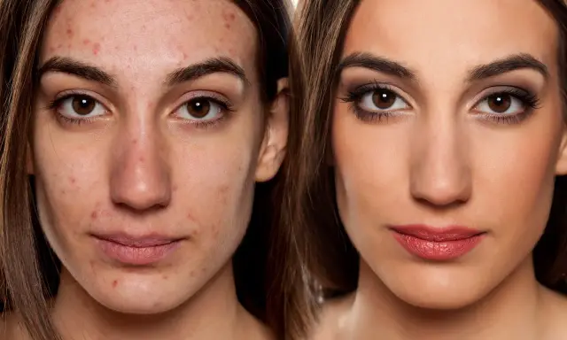 Vorher-Nachher-Vergleich: Haut mit Akne und perfekt geschminktes Gesicht. Hausmittel zum Make-up fixieren können helfen.