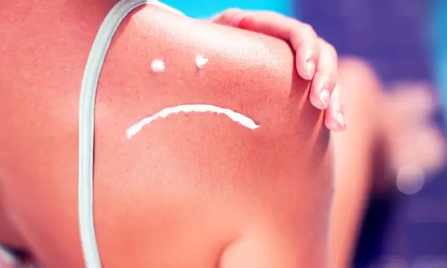 Sonnenbrand auf der Schulter mit traurigem Gesicht aus Creme. Hilfreiche hausmittel bei sonnenbrand lindern die Beschwerden.