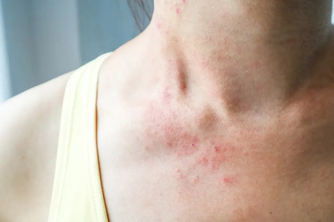 Rotes Dekoltee wie Sonnenbrand, mit kleinen roten Flecken und Reizungen, die sich über den Hals und die Brust erstrecken.
