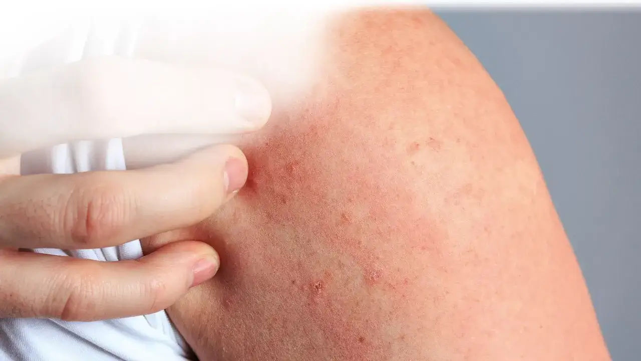 Rote, gereizte Haut mit kleinen Pickelchen, die auf Stress und Juckreiz hindeuten. Ein Finger kratzt an der betroffenen Stelle.