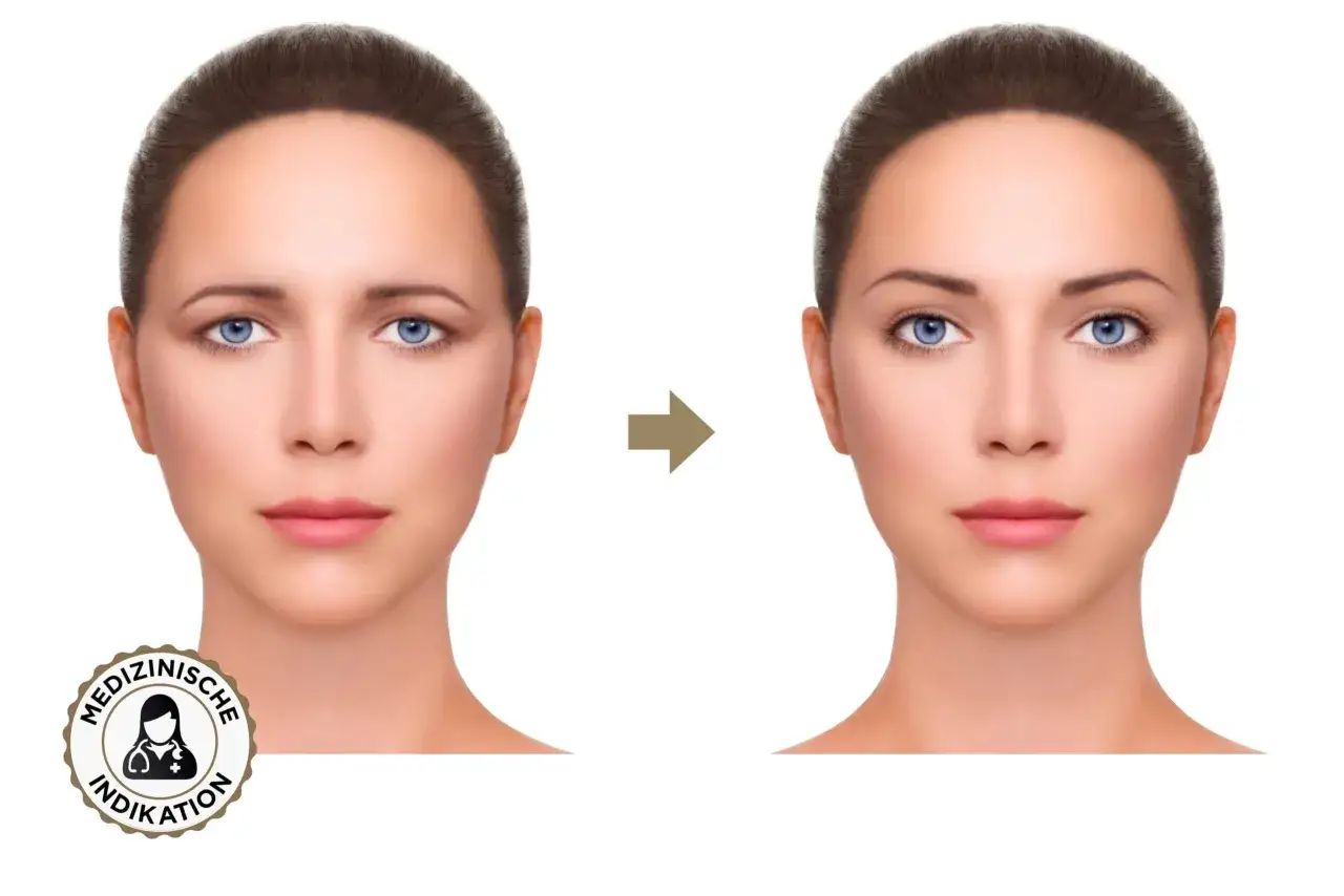 Vorher-Nachher-Vergleich: Was ist Brow Lifting? Die Augenbrauen werden angehoben, was dem Gesicht einen offeneren Ausdruck verleiht.