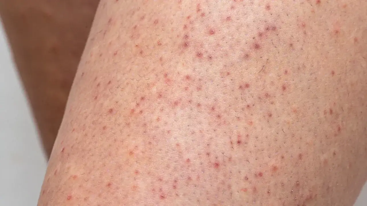 Haut mit vielen kleinen roten Pickeln an den Beinen, die auf eine Entz&uuml;ndung der Haarfollikel hindeuten.