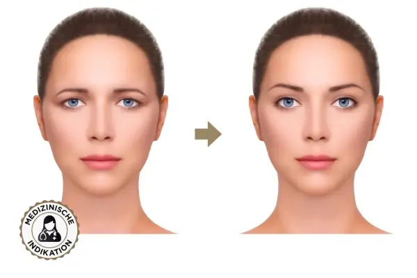 Vorher-Nachher-Vergleich: Was ist Brow Lifting? Die Augenbrauen sind angehoben, das Gesicht wirkt jugendlicher und offener.